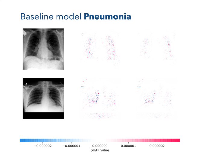 baseline_model_pneumonia