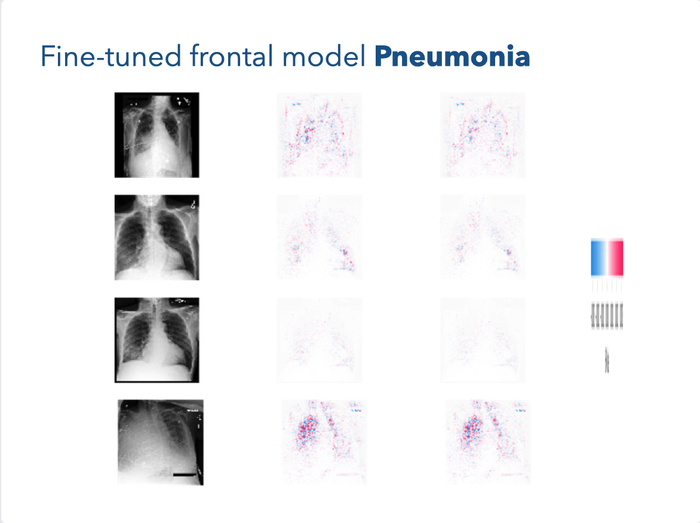 finetuned-frontal model pneumonia
